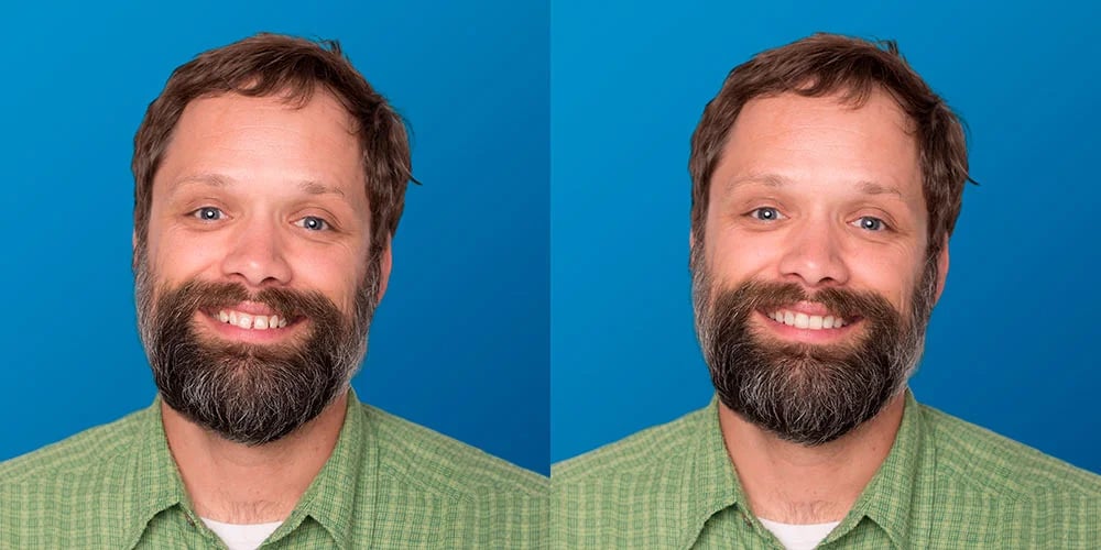 SmileView before and after 4