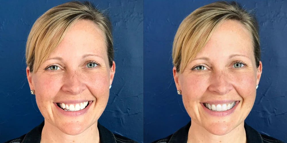 SmileView before and after 2